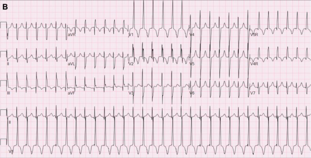 ECG of junctional ectopic tachycardia at about 205 beats per minute in a 2-month-old with ventriculoatrial dissociation