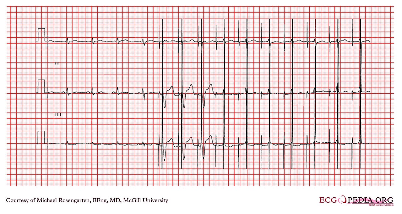 Dual-chamber pacemaker rhythm strip during magnet application, with asynchronous pacing spikes at a fixed rate