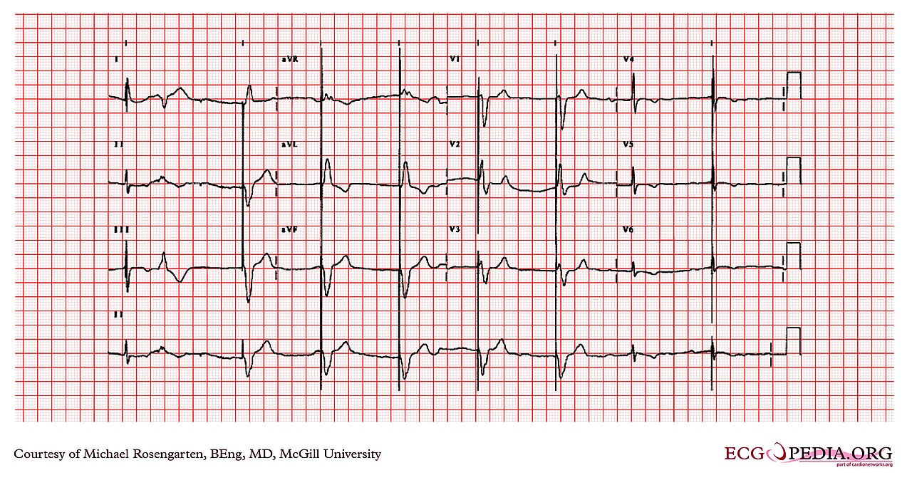 12-lead of a VVI pacemaker: pacing spikes precede wide ventricular complexes, with a fusion beat
