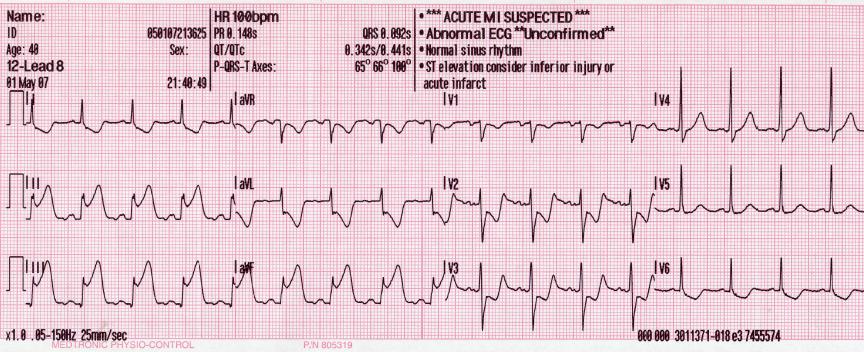12-lead ECG with ST elevation in II, III and aVF; right-sided leads not shown
