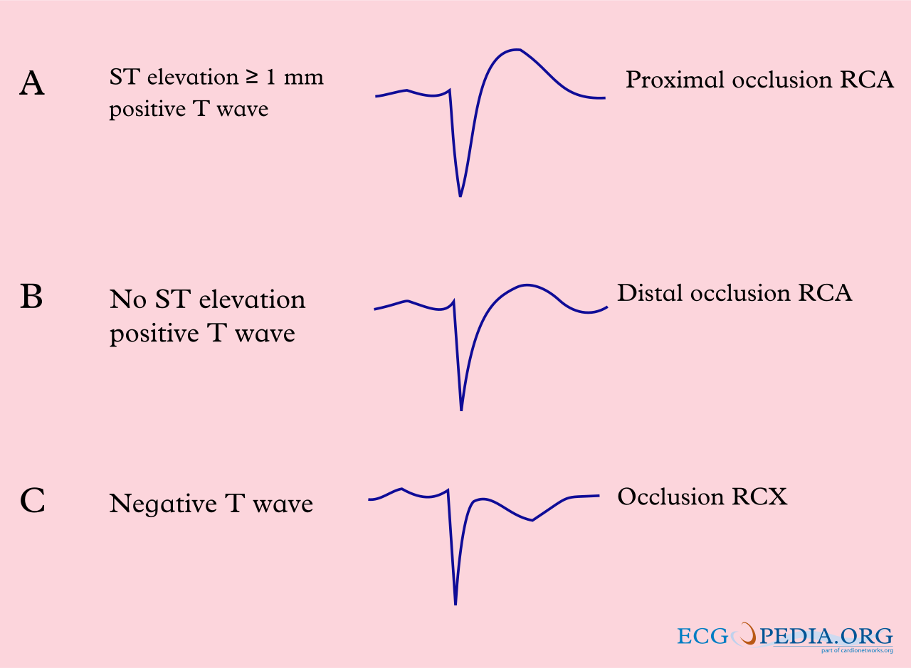 Schematic of V4R ST-T morphology: proximal RCA occlusion with ST elevation of 1 mm or more, compared with distal RCA and circumflex patterns