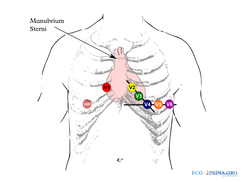 Chest diagram with V4R on the right chest, the mirror image of V4 on the left