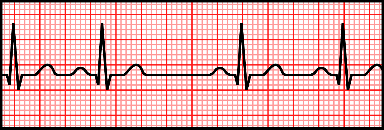 Schematic of sinus arrhythmia with an upright P wave before each QRS and R-R intervals that vary