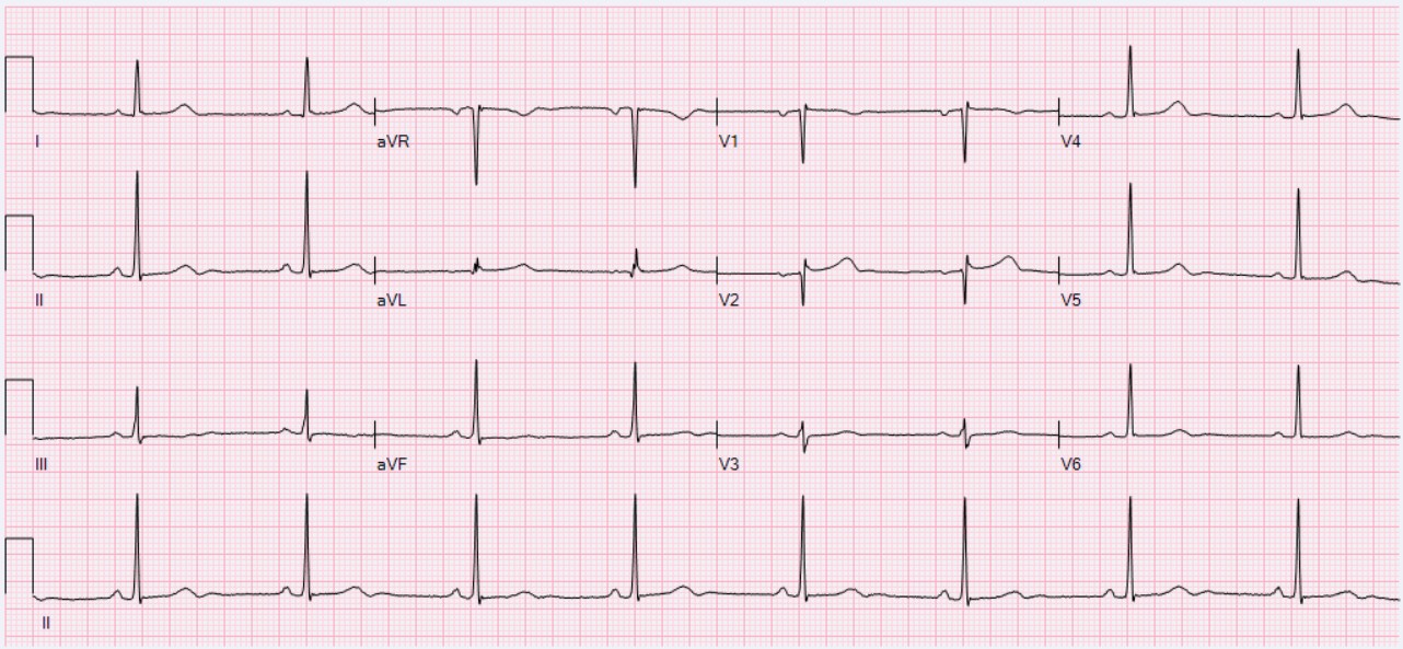 12-lead ECG of sinus bradycardia at about 49 per minute with a P wave before each QRS