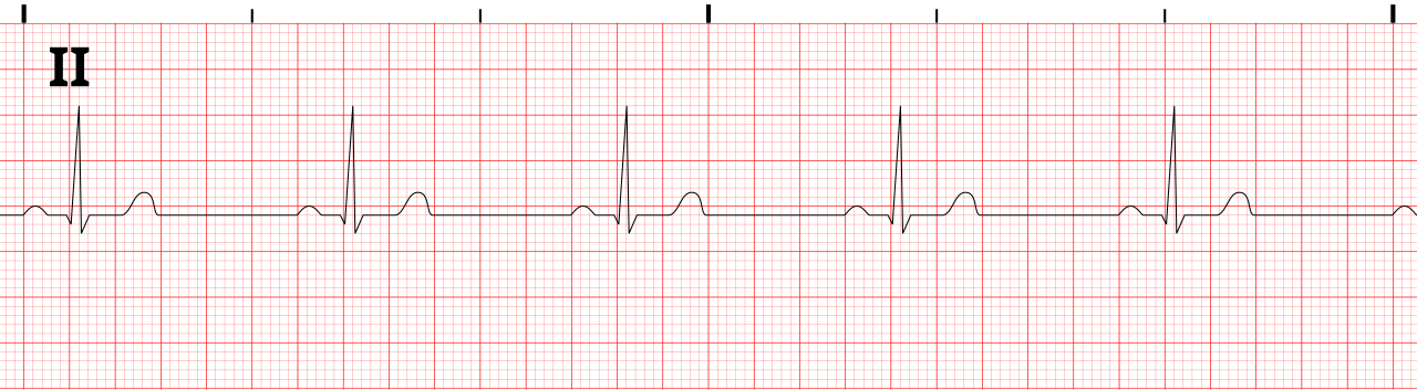 Lead II six-second strip of slow regular sinus rhythm with an upright P wave before each QRS