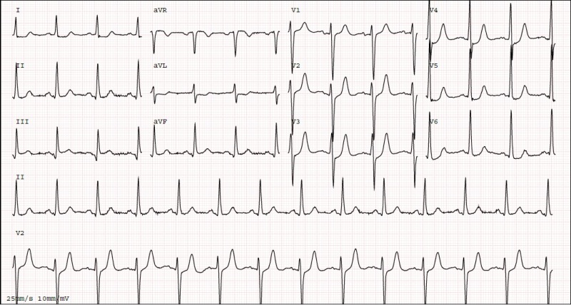 12-lead ECG of de Winter pattern: upsloping ST depression with tall symmetric T waves in the precordial leads