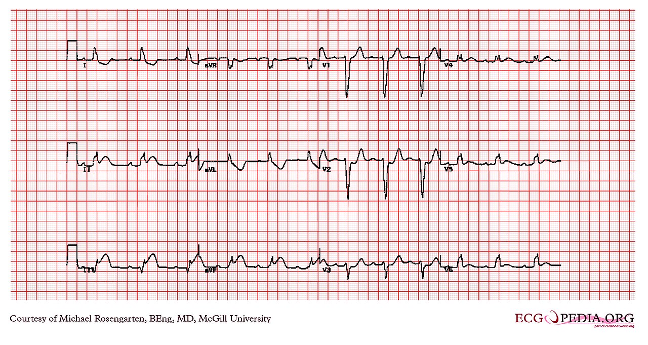 12-lead ECG of left bundle branch block with ST changes in the same direction as the QRS in the anterior leads