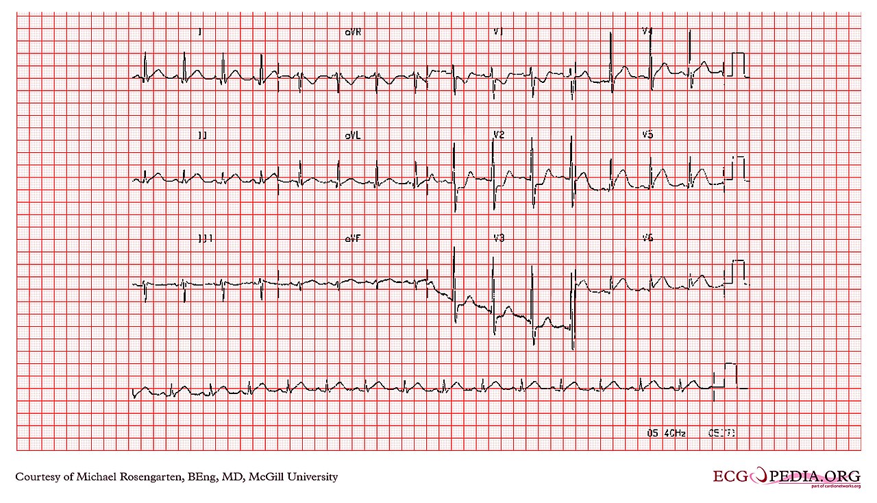 12-lead ECG of posterior MI: ST depression and tall R waves in leads V1 to V3
