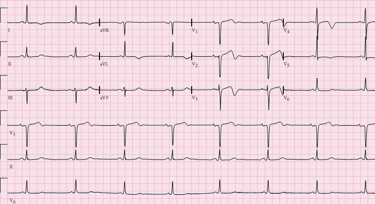 12-lead ECG with Wellens-type T-wave changes in the anterior precordial leads