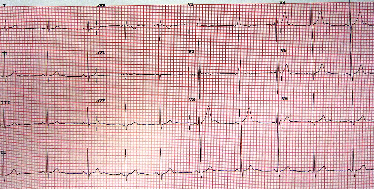 12-lead ECG of a 15-year-old male with benign early repolarization: J-point notching and elevation