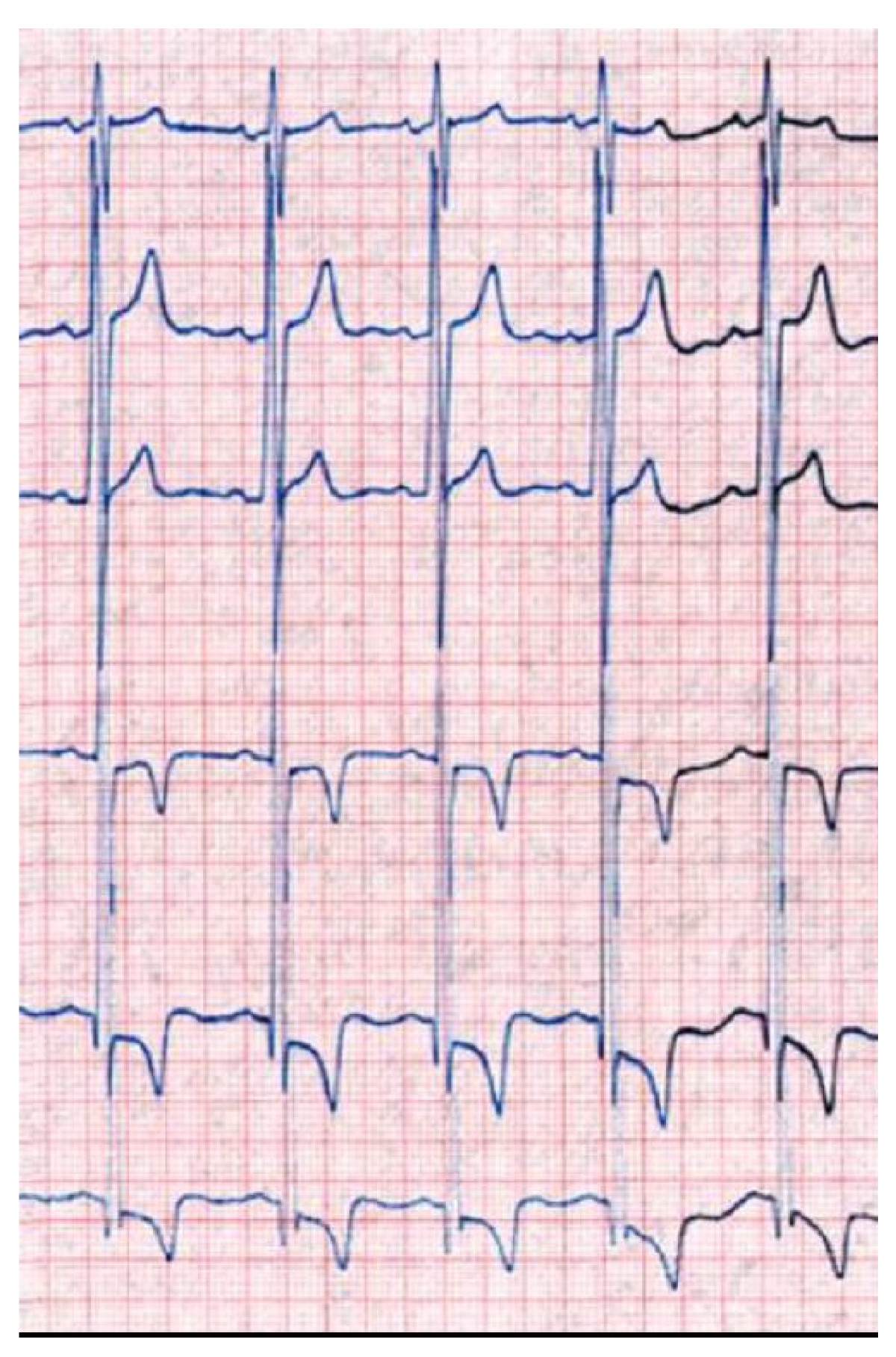 12-lead ECG with LVH voltage, ST depression and negative T waves in the left leads (Fabry disease)