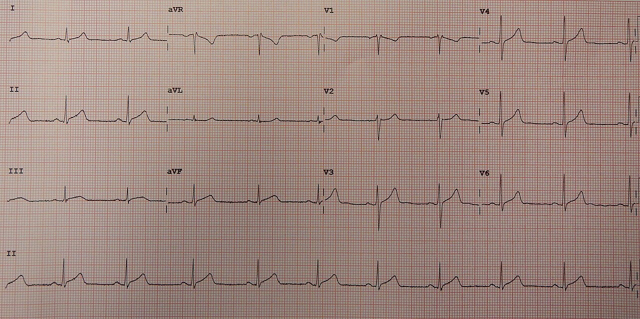 12-lead ECG with diffuse ST elevation in many leads, not limited to one coronary territory (acute pericarditis)