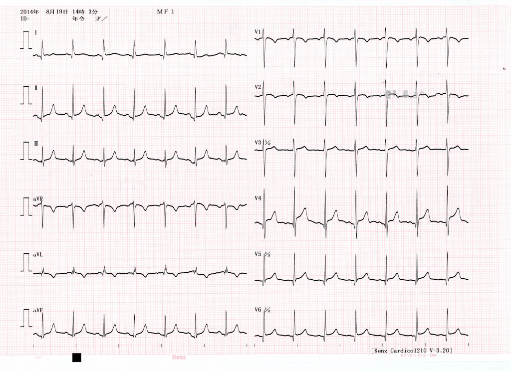 12-lead ECG from a patient with takotsubo cardiomyopathy showing T-wave inversion in aVR, aVL and V1–V2