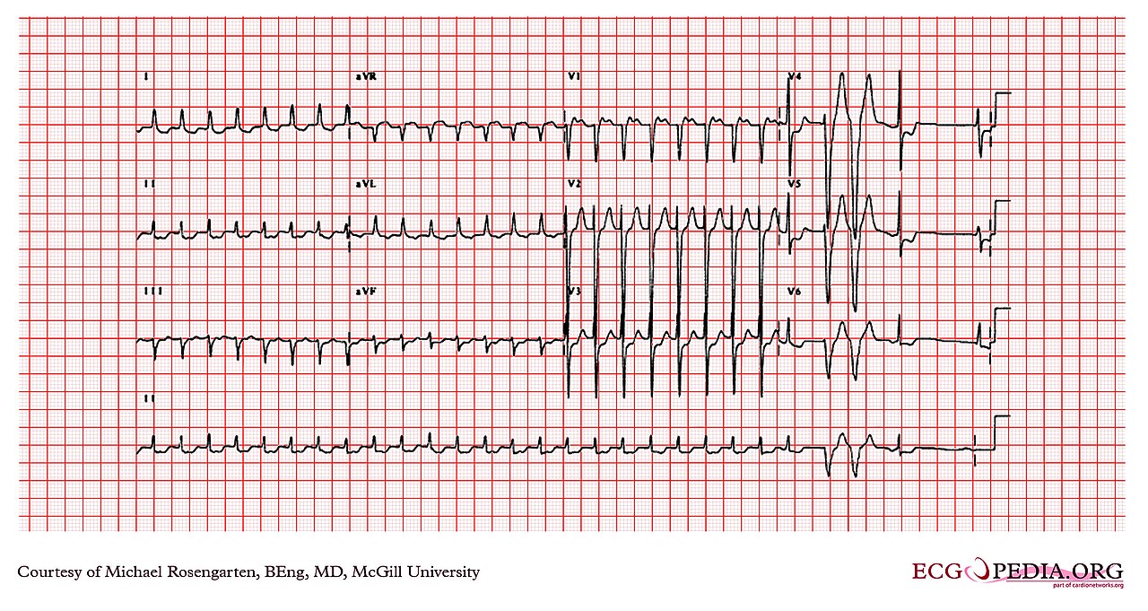 12-lead ECG of a narrow-complex tachycardia in the limb leads and V1–V3, with wide, changing complexes in V4–V6