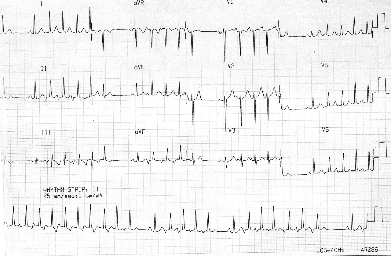 Narrow-complex tachycardia on a 12-lead ECG with a lead II rhythm strip; the source is titled Coumel tachycardia
