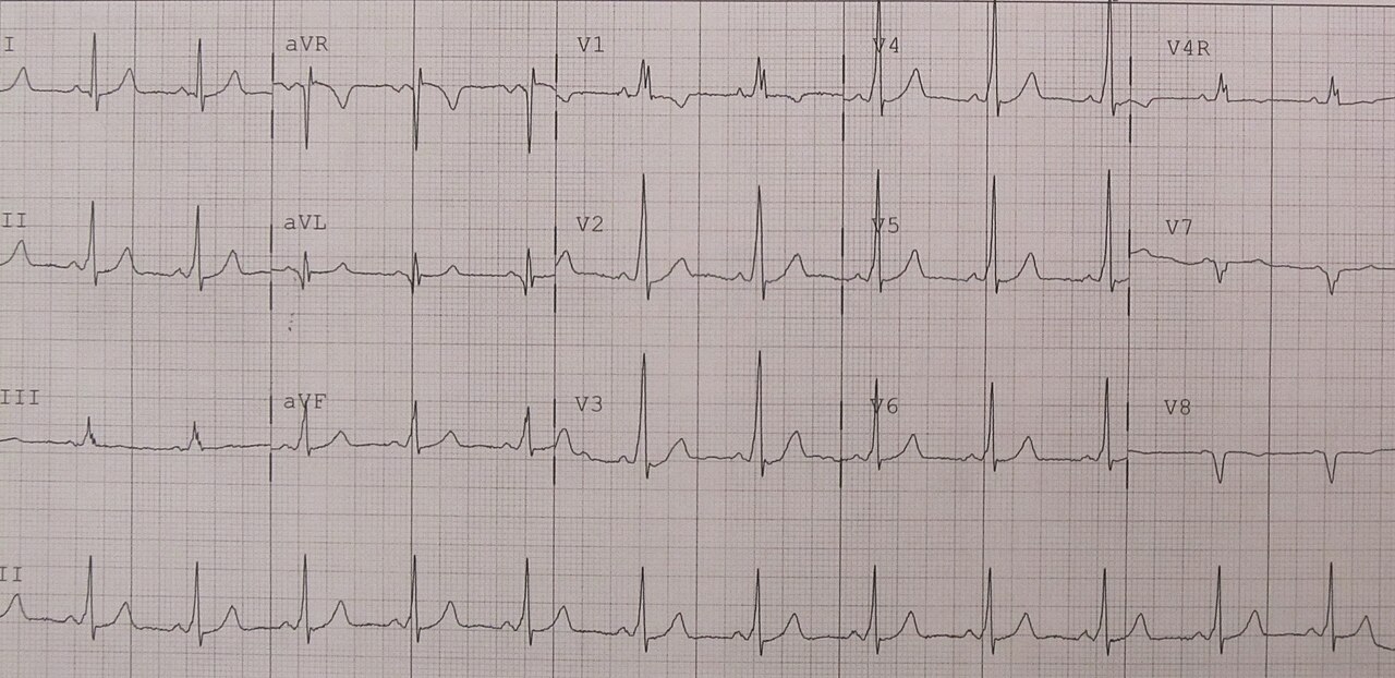 12-lead ECG in sinus rhythm labelled Wolff-Parkinson-White syndrome; pre-excitation is subtle on this tracing