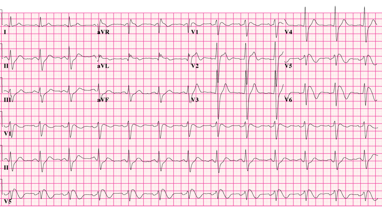 Brugada syndrome type 1 ECG: coved ST elevation with negative T waves in right precordial leads V1 and V2