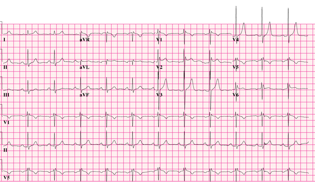 Brugada type 2 ECG: saddleback ST elevation in V1 and V2 without a coved type 1 pattern