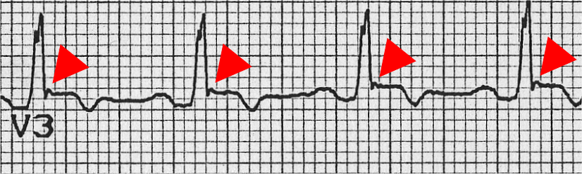 Epsilon waves (red arrows) after the QRS in lead V3 in arrhythmogenic right ventricular cardiomyopathy
