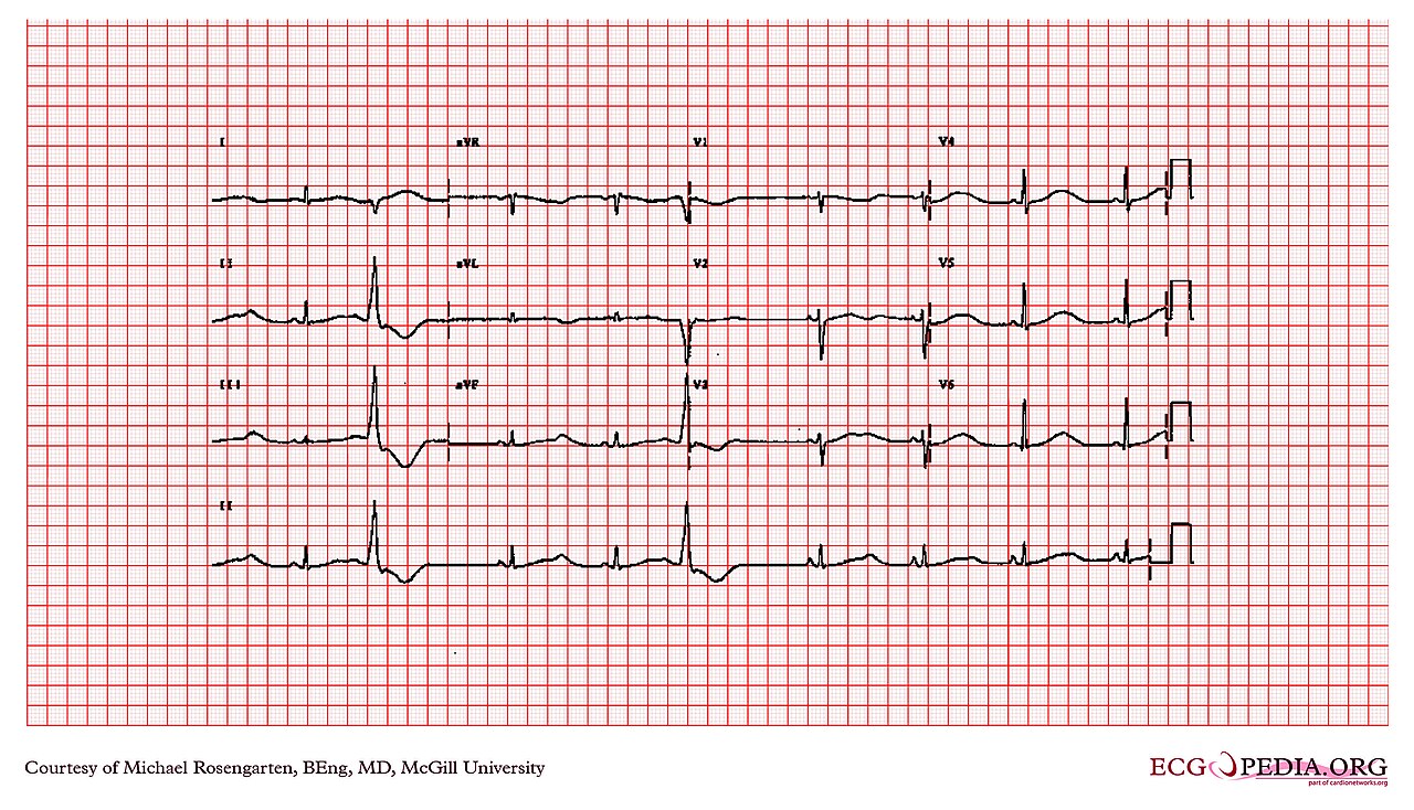 12-lead ECG from a patient with Romano-Ward long QT syndrome