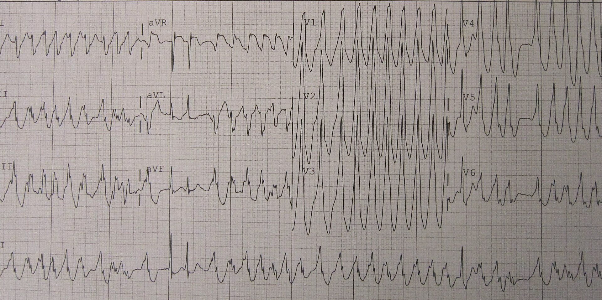 12-lead ECG of ventricular tachycardia: rapid, wide complexes across the limb and precordial leads