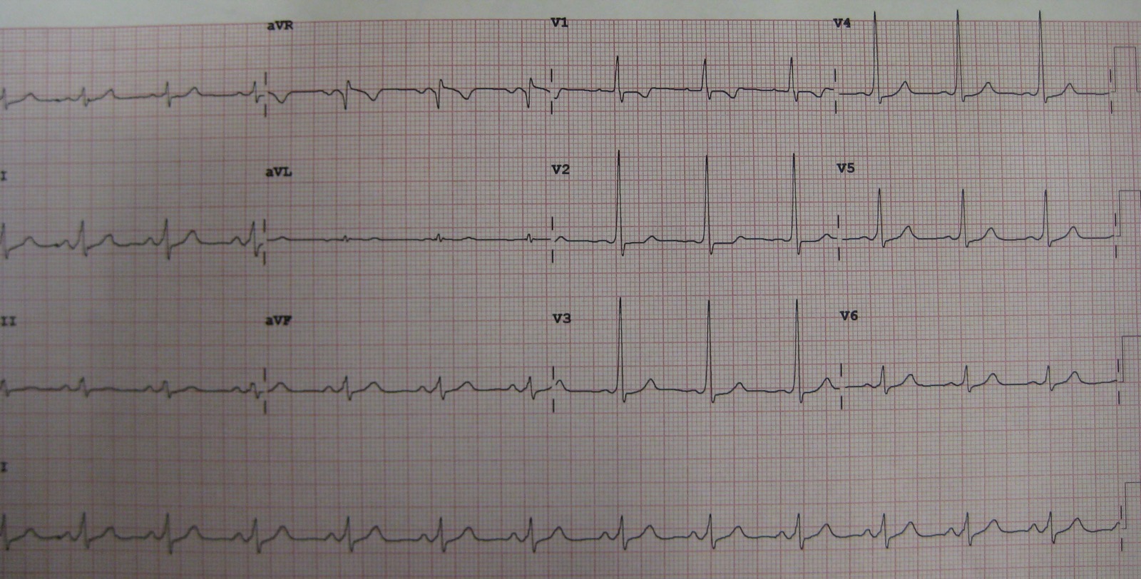 12-lead ECG in sinus rhythm showing a short PR interval and delta waves in several leads