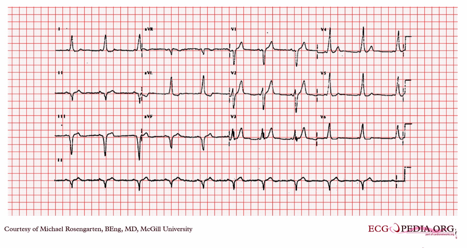 Sinus-rhythm 12-lead ECG with a short PR interval and slurred QRS upstroke, best seen in leads I, aVL and V2 to V6