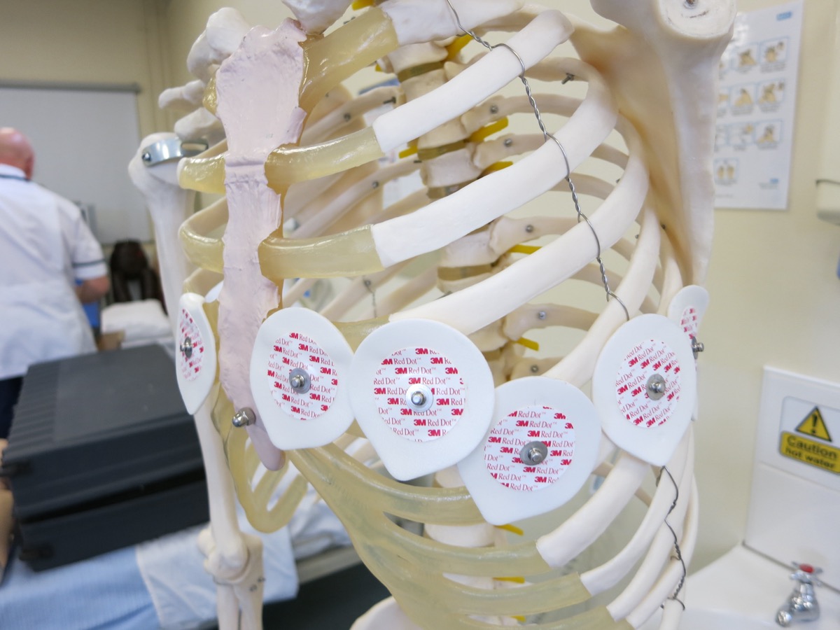 Adhesive electrodes on the front of a plastic skeleton teaching model; the pad positions are not a placement standard
