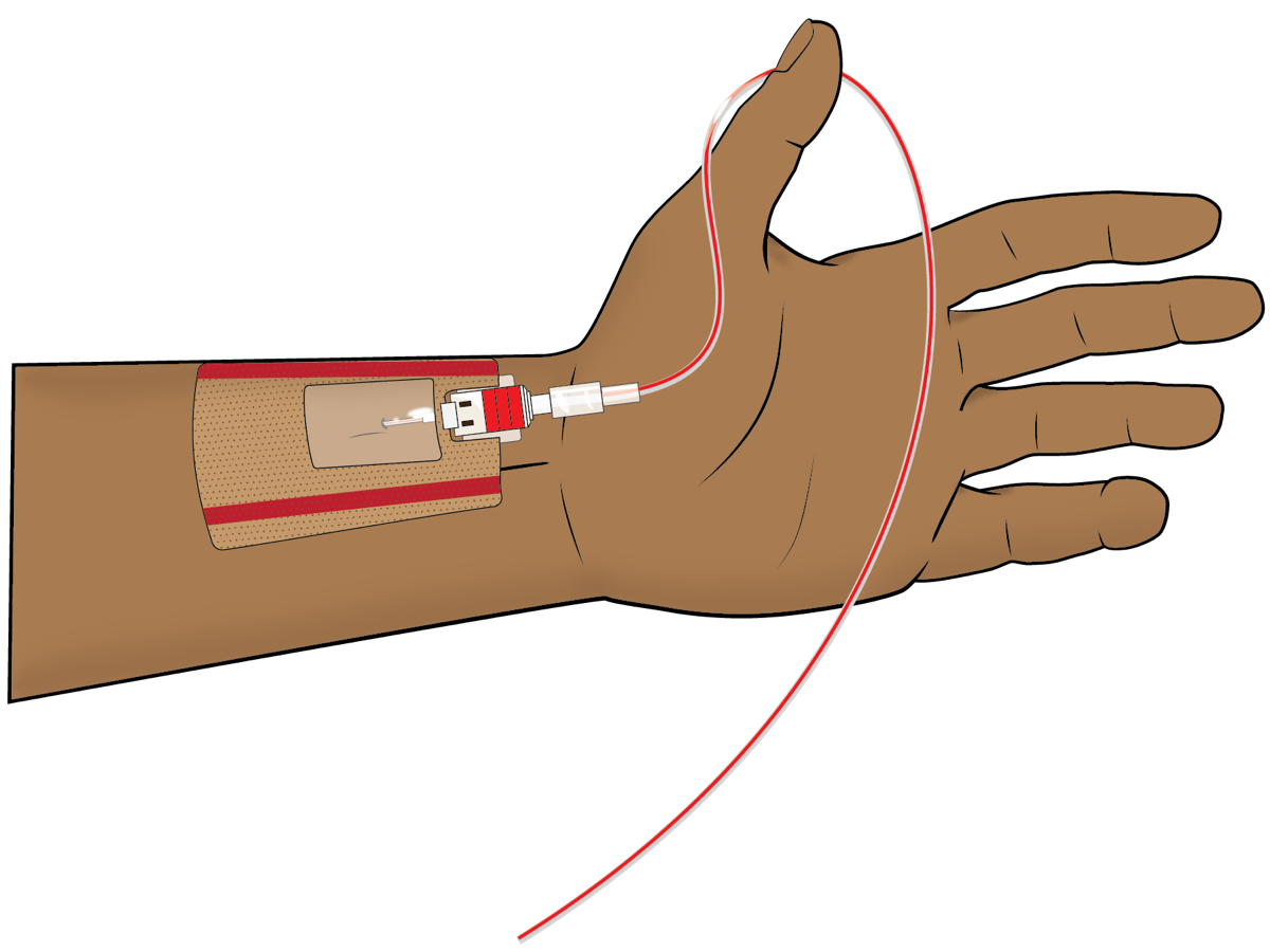 Illustration of an arterial catheter in the left radial artery under a dressing