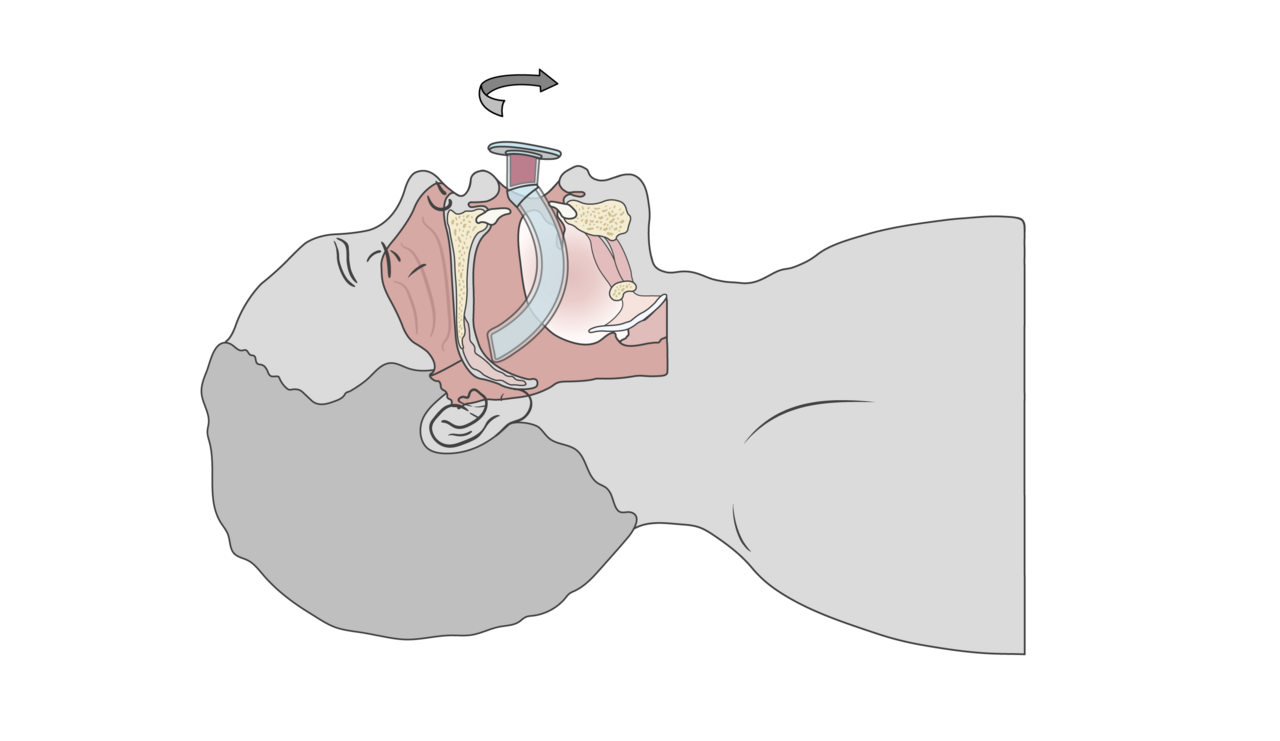 Oropharyngeal airway inserted with its tip toward the palate and rotated 180 degrees over the tongue