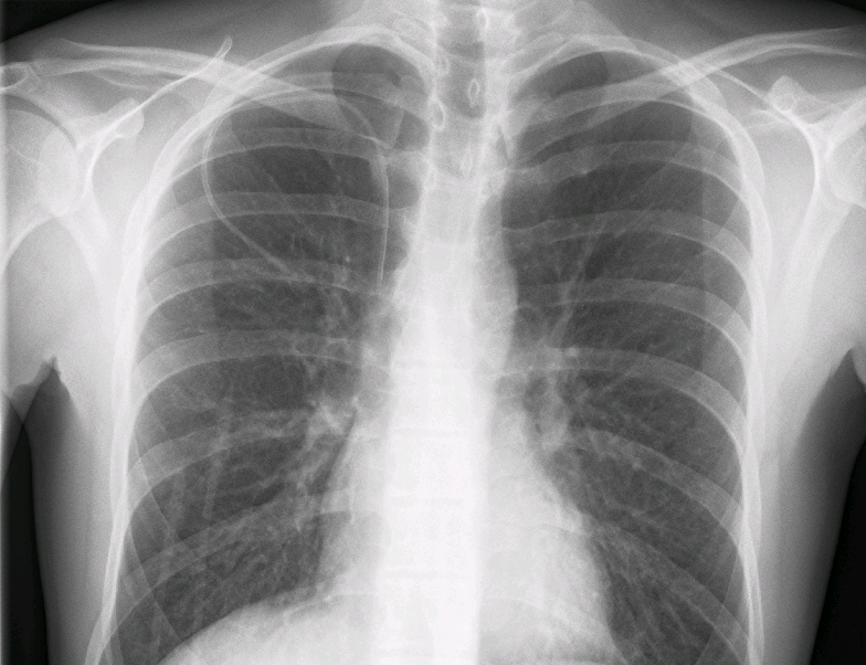 Chest radiograph of a right subclavian central venous catheter