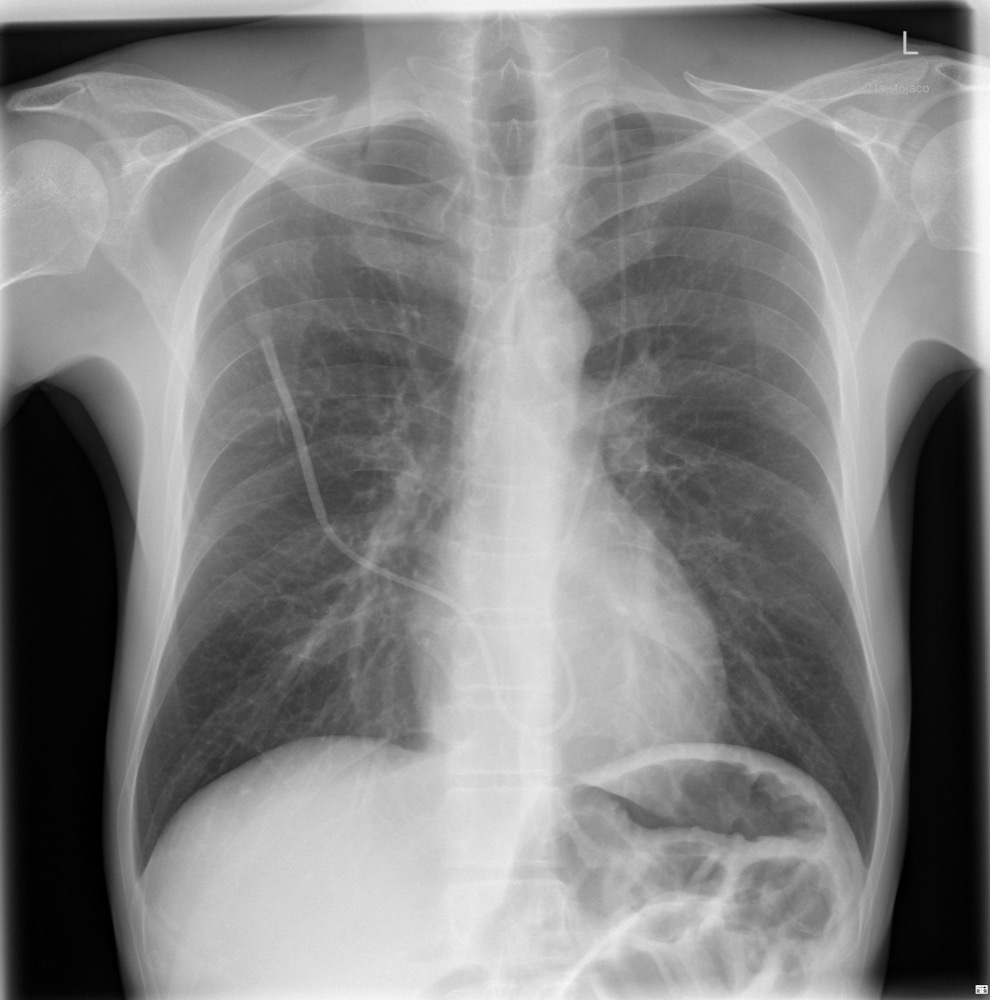 Chest radiograph with a central venous catheter; the tip is not annotated