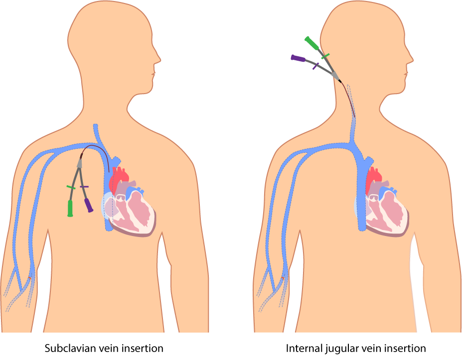 Diagram comparing subclavian and internal jugular central venous catheter insertion on a torso outline
