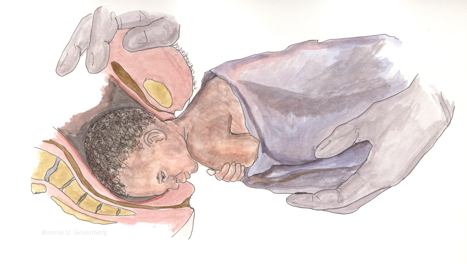 Watercolor of a breech birth: the head emerging, the body supported by a hand under the infant in a blanket