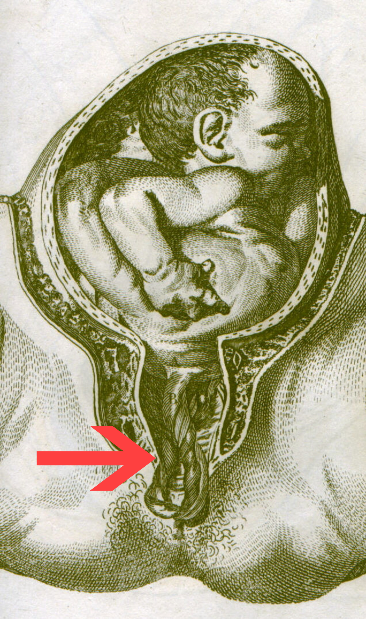 Historical engraving of a prolapsed umbilical cord lying below the fetal head in the birth canal, arrow marking the cord