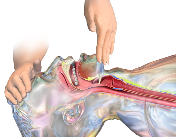 Illustration of an adult head tilted back with the chin lifted, showing the tongue, larynx and trachea