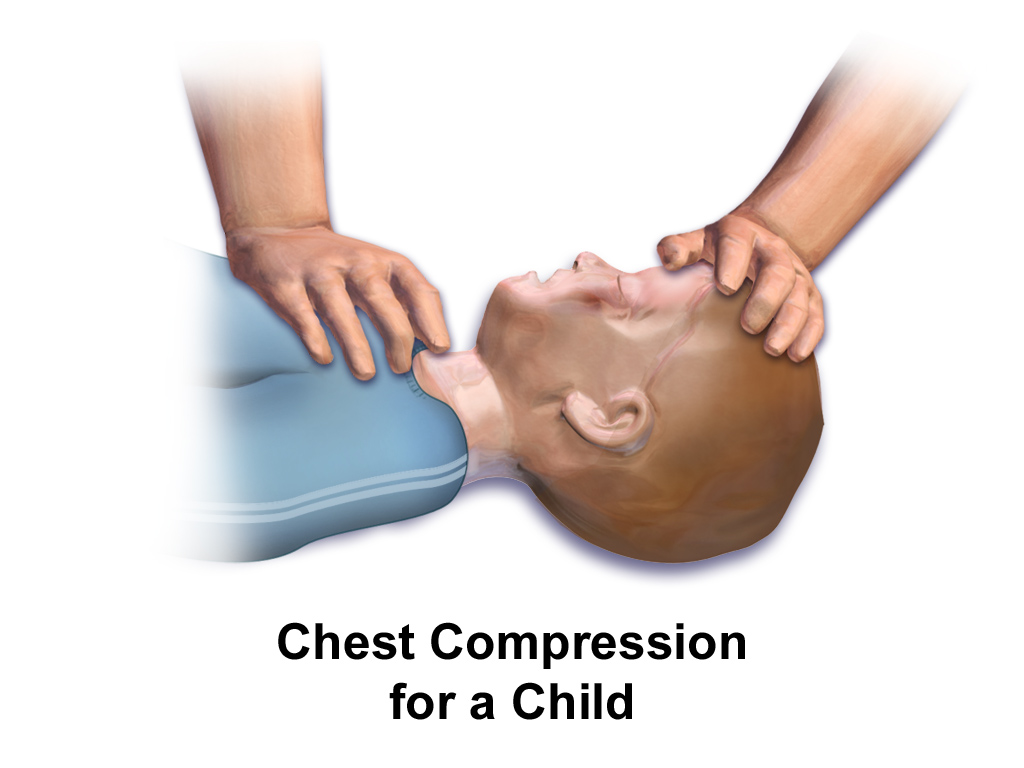 Illustration of a child being compressed with the heel of one hand on the lower sternum