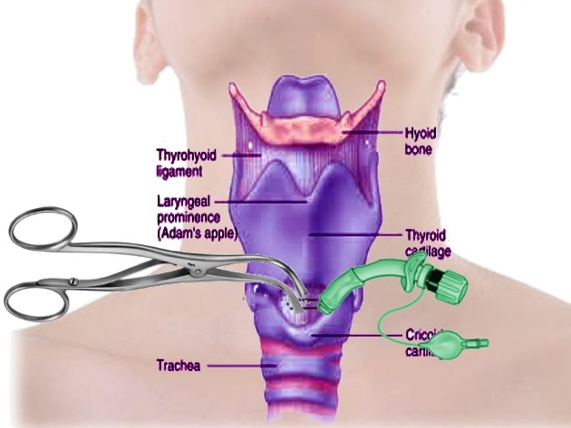 Anterior neck diagram with thyroid and cricoid cartilage landmarks and a cuffed airway tube in place