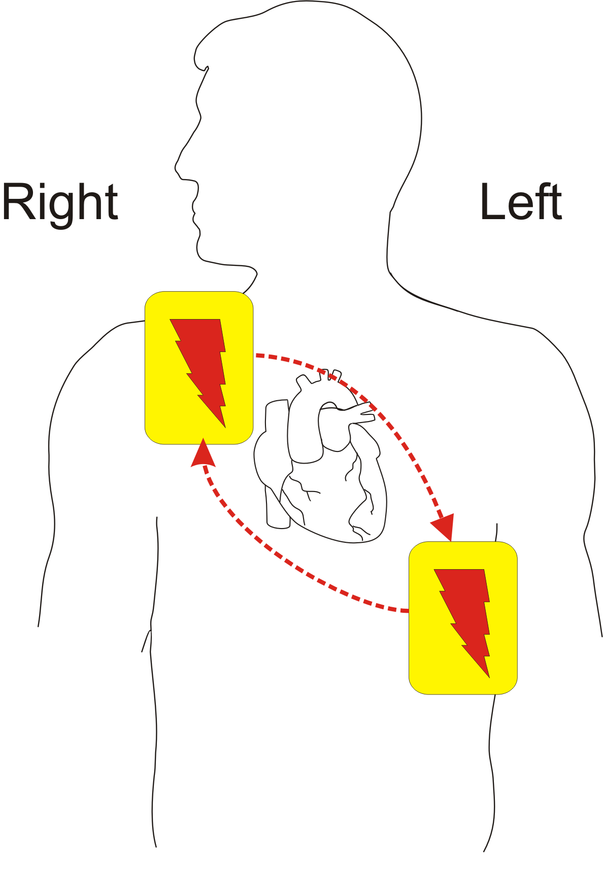 Anterolateral defibrillator pad positions: one pad on the right upper chest below the clavicle, one on the left lateral chest