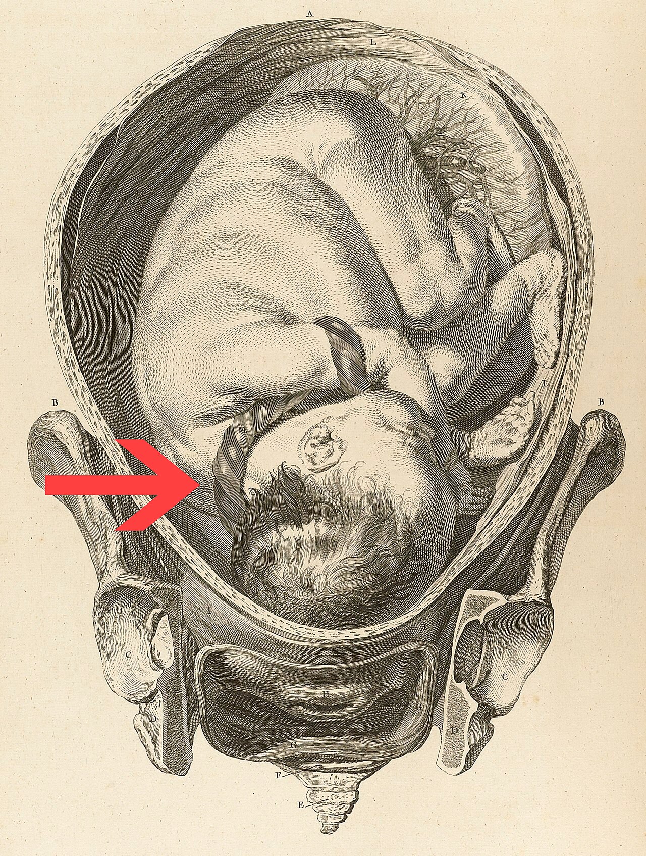 Historical engraving of a fetus in the uterus with the umbilical cord wrapped around the neck, marked by an arrow