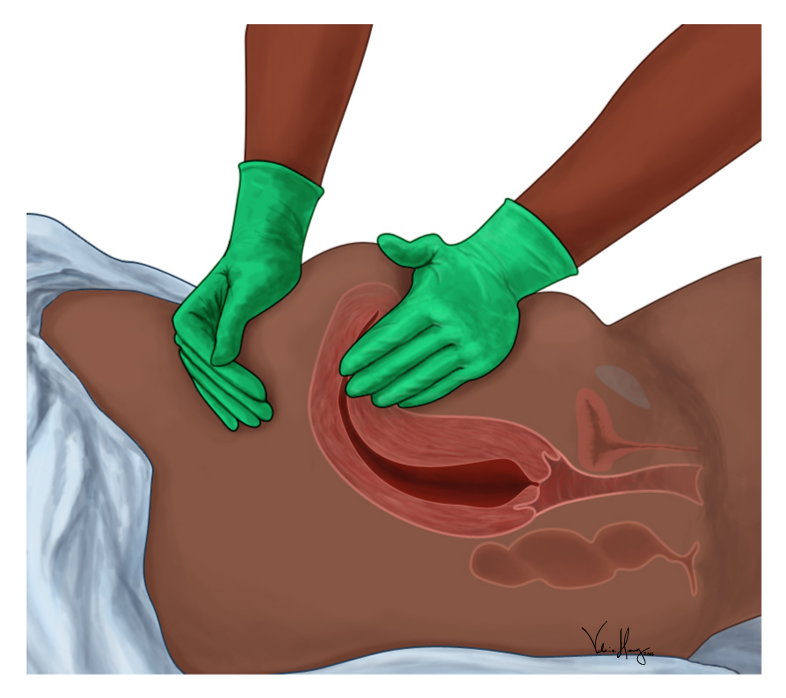 Side view with internal anatomy: gloved hands on the fundus with the uterus shown in red