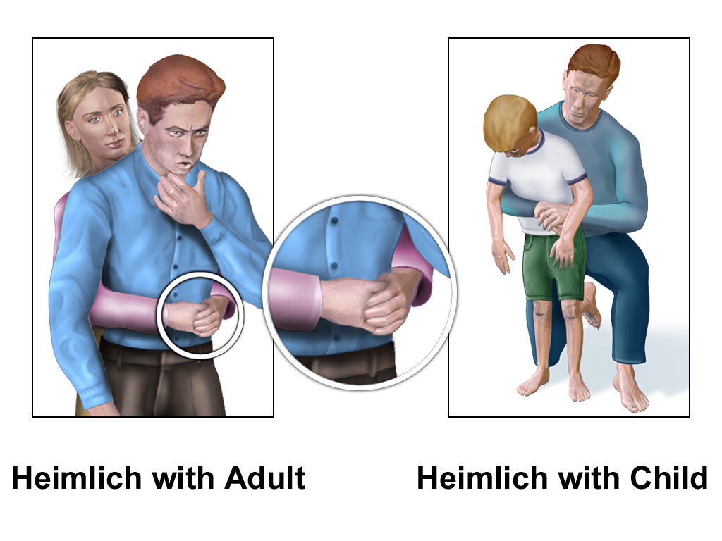 Illustration of abdominal thrusts on an adult and on a child, with the fist placed above the navel