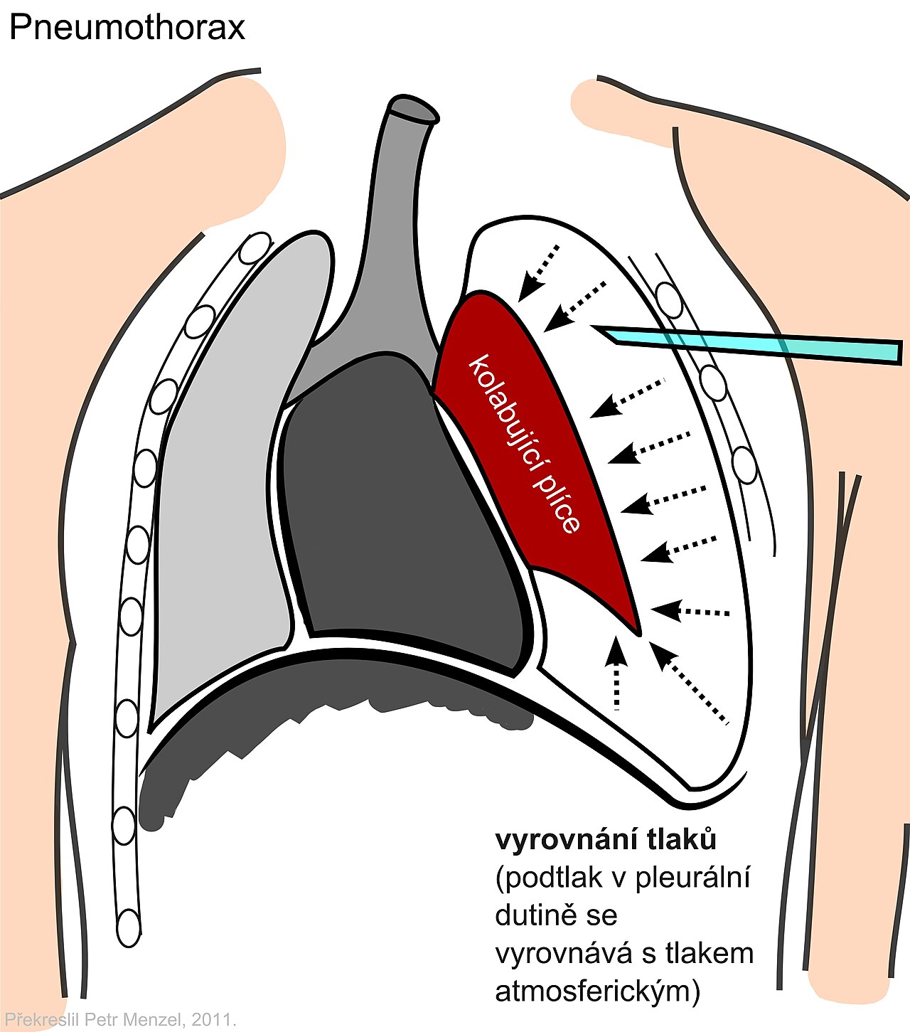 Diagram of a tension pneumothorax: the collapsed lung is shaded red and air fills the pleural space; a needle enters the lateral chest wall