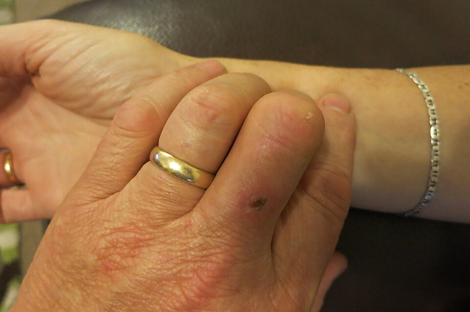 Two fingers palpating the radial pulse on the wrist