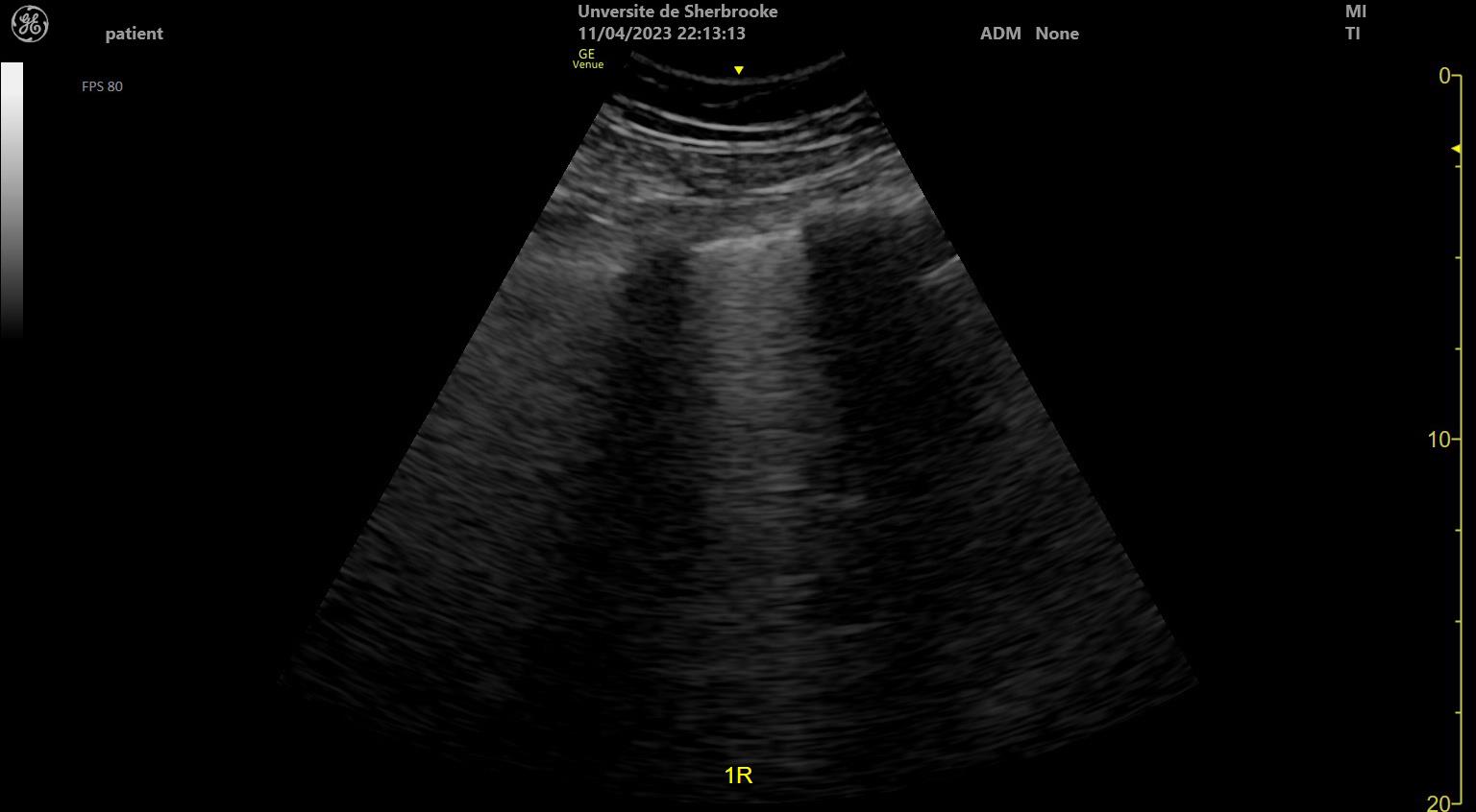 B-mode lung ultrasound showing vertical hyperechoic B-lines arising from the pleural line