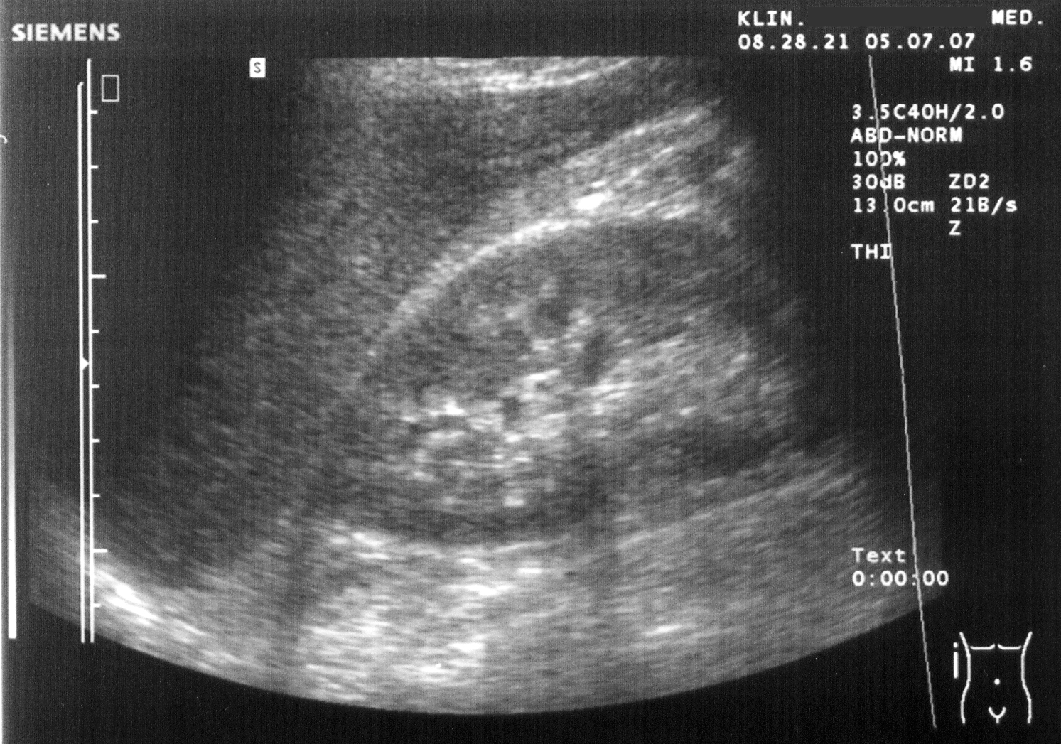 Grayscale right upper quadrant ultrasound showing liver and right kidney, the window for free fluid in Morison's pouch