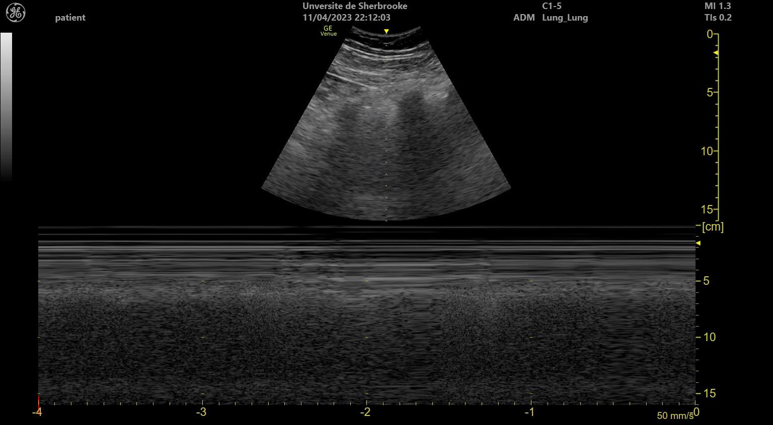 M-mode lung ultrasound with a granular pattern below the pleural line and horizontal lines above, the seashore sign of lung sliding