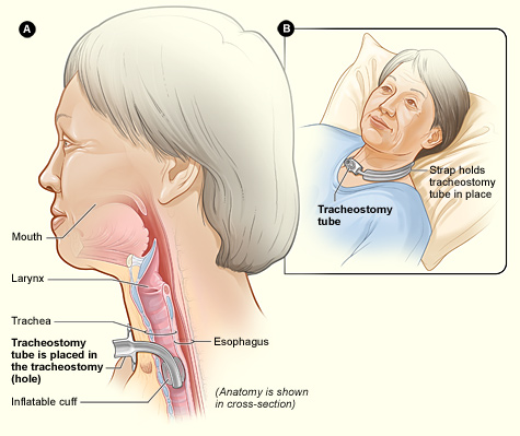 Cross-section of a tracheostomy tube placed through the neck, with the inflatable cuff inside the trachea