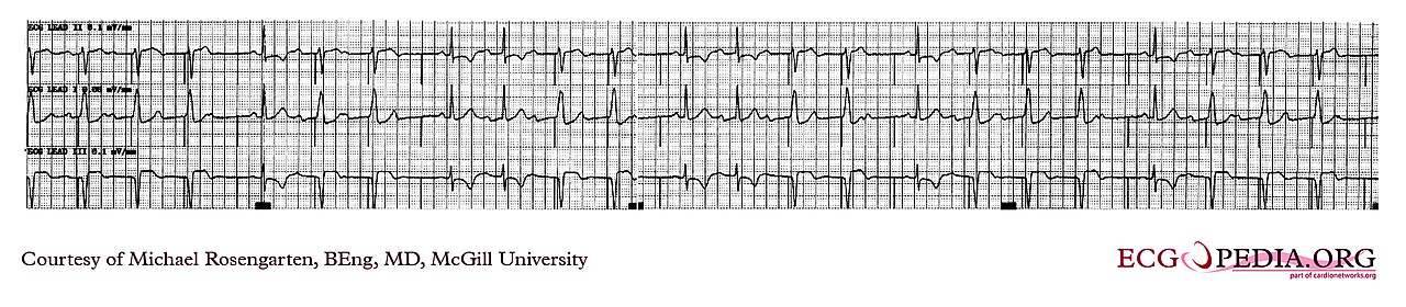 Rhythm strip with pacing spikes, some followed by no ventricular complex, showing time-dependent capture failure
