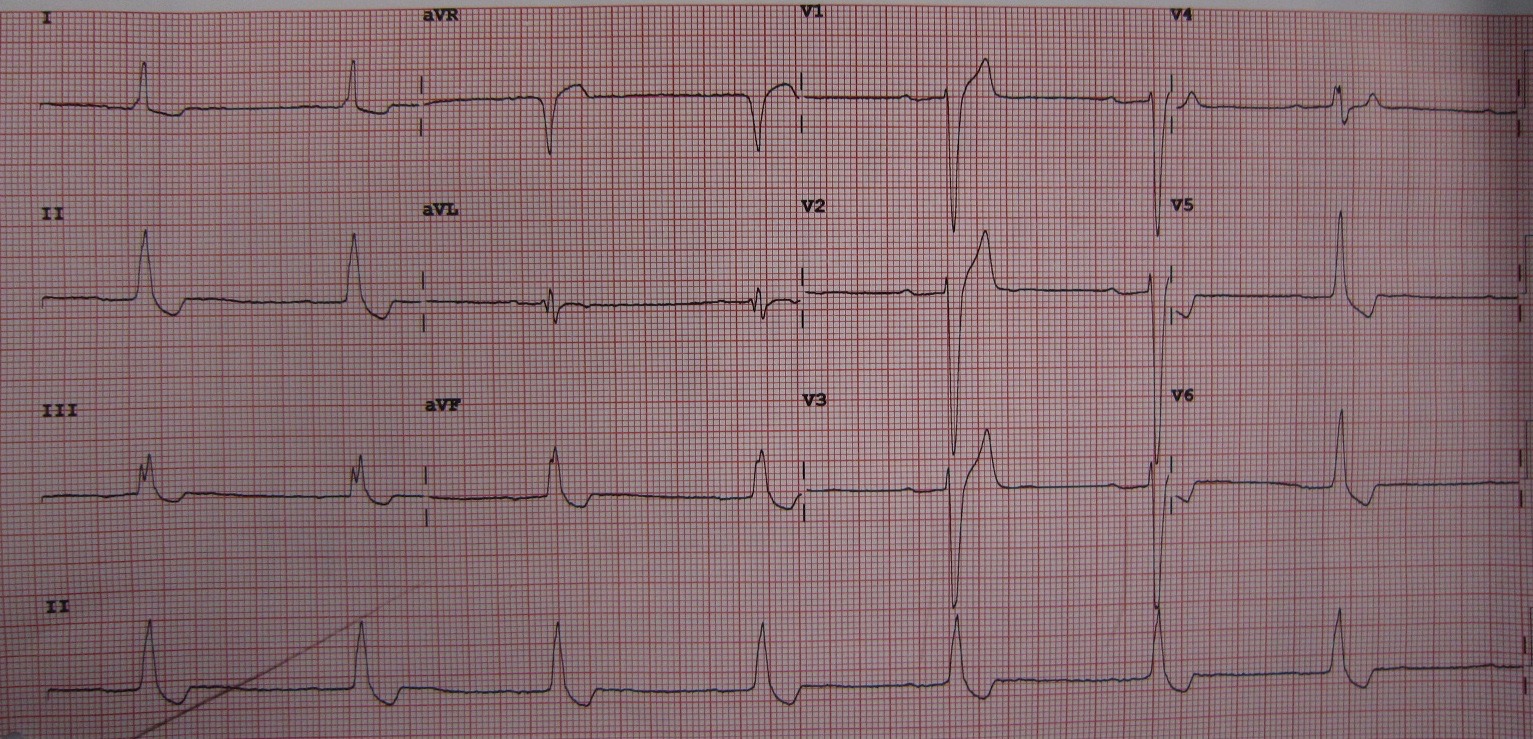 12-lead ECG: slow regular rhythm without clear P waves and scooped, sagging ST depression in inferior and lateral leads